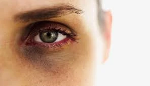 درمان تیرگی زیر چشم با میکرونیدلینگ